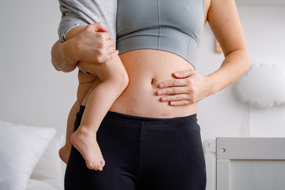 Bladder Injury After C-section
