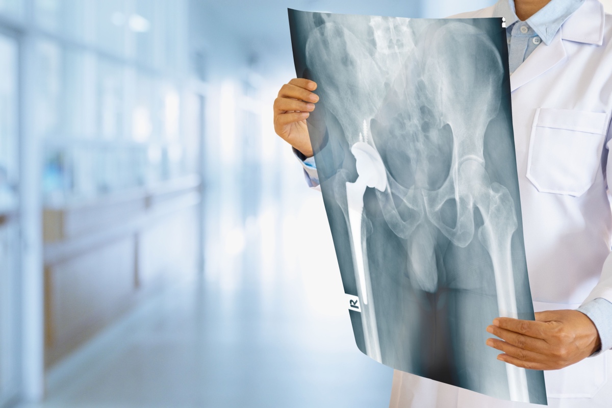 Wright Profemur Z Hip Replacement