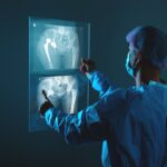 Hip Replacement