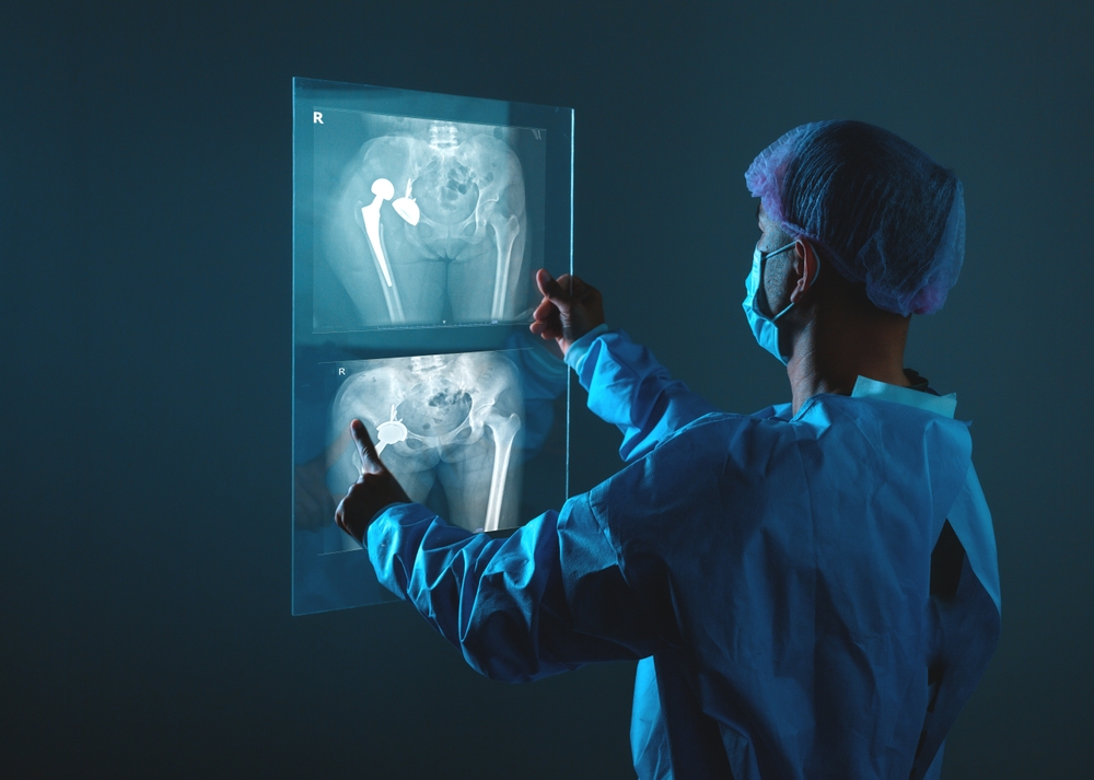 Hip Replacement