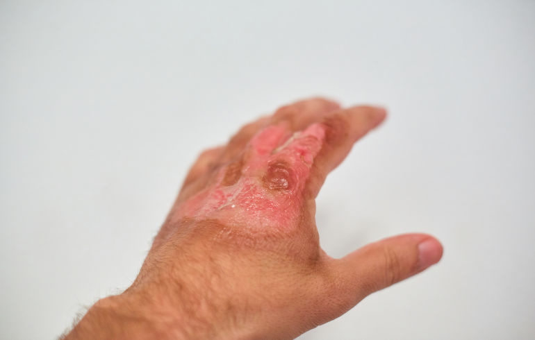 Martinsburg Burn Injury Lawyers Can Help You