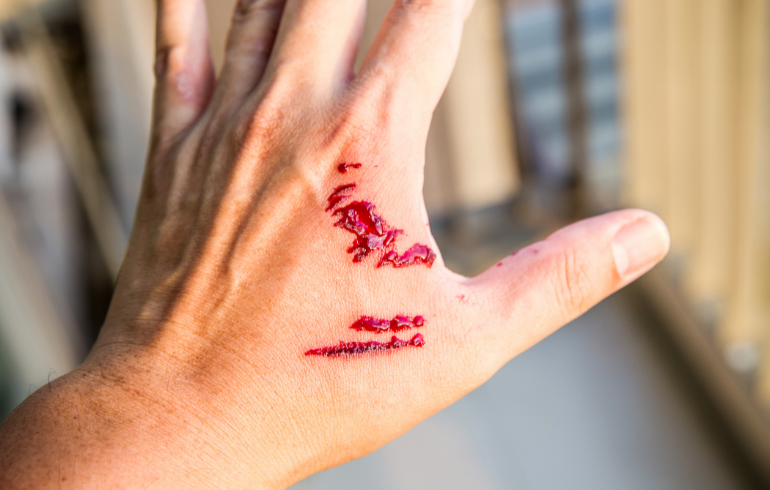 Martinsburg Dog Bite Victims Choose Manchin Injury Law