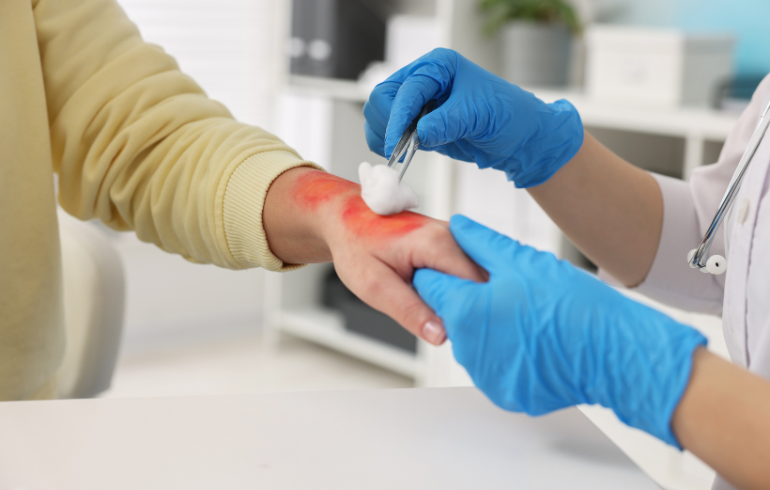 ​Understanding West Virginia Burn Injury Laws